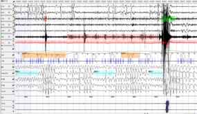 値下げしました。　日本睡眠学会　学習用PSGチャート 睡眠ポリグラフィ装置 PSG-1100｜SAS・PSG関連機器｜製品情報